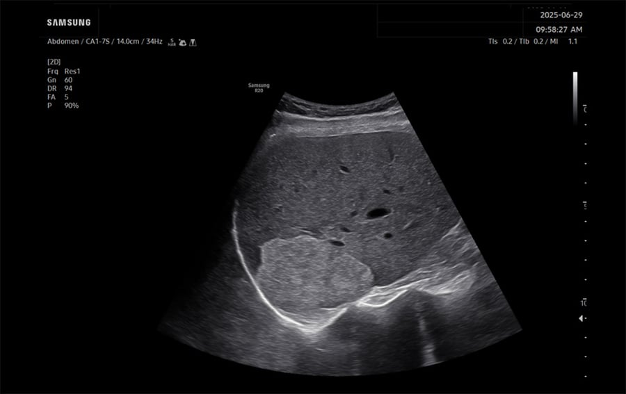 samsung-R20-Liver-Mass