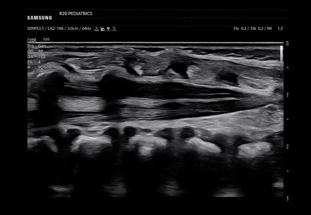 samsung-R20-Peds-Dimplet