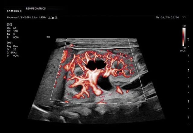 samsung-R20-Peds-Kidney-MVFlow