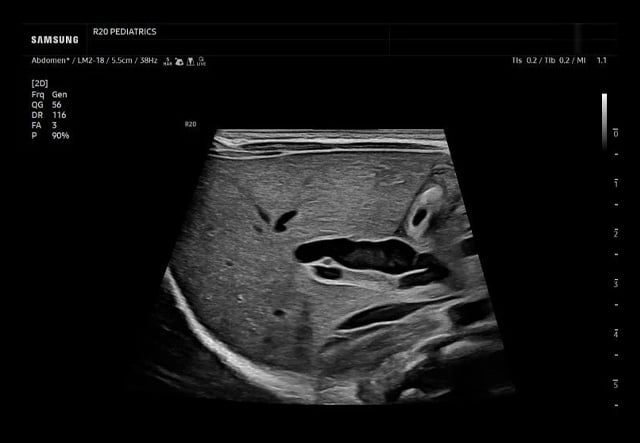 samsung-R20-Peds-abdomen2