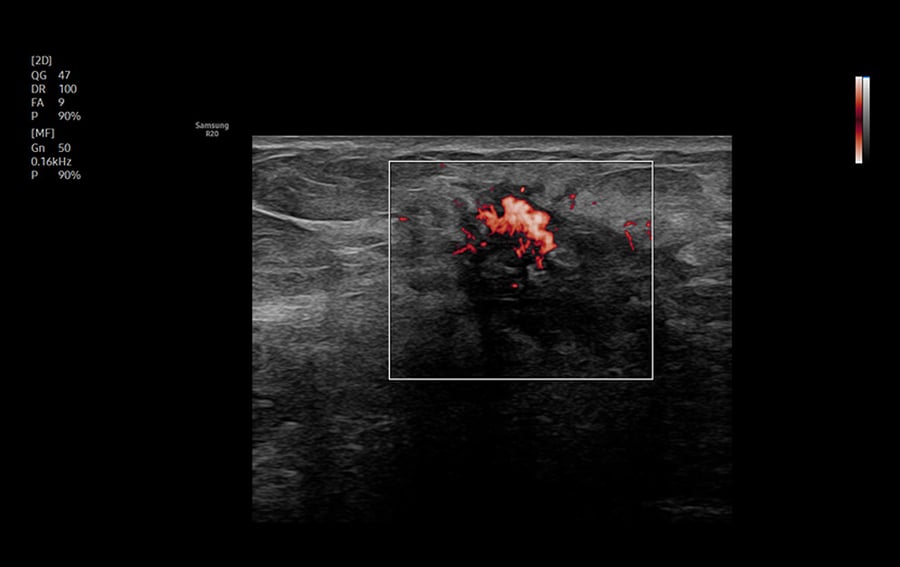 samsung-R20-mv-flow-breast