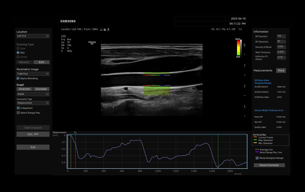 samsung-r20-Carotid-AutoIMT
