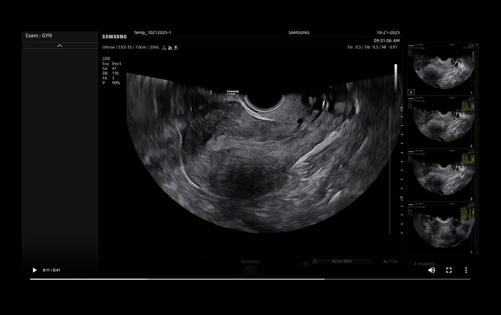 samsung-r20-uterine-assist-thumbnail