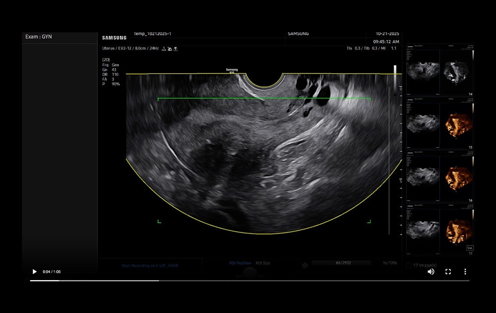 samsung-uterine-contour-thumbnail
