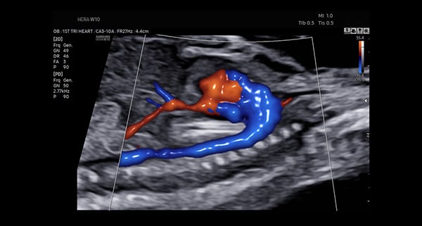 usa-WH-HERA W10 Detailed Vessel Imaging_Fetal Aortic Arch-LumiFlow