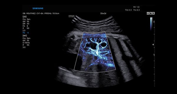 usa-WH-HERA W10 Detailed Vessel Imaging_Fetal Kidney-MV-Flow