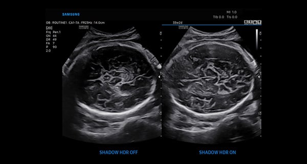 usa-WH-HERA W10_ Sophisticated 2D_Fetal Brain-ShadowHDR