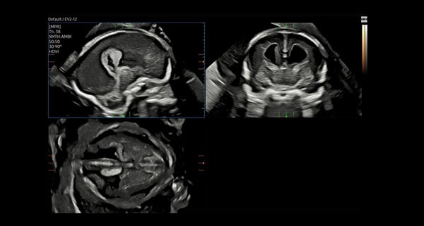 usa-WH-HERA W10_Clinical Images_3D Fetal Brain-HDVI-1