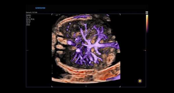 usa-WH-HERA W10_Clinical Images_Fetal Abd Vasc-MV-Flow 3D