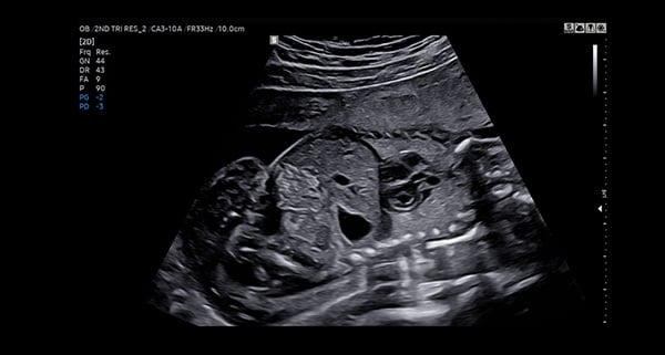 usa-WH-HERA W10_Clinical Images_Fetal Abdomen-Thorax_ClearVision-1