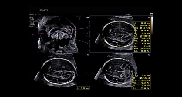 usa-WH-HERA W10_Clinical Images_Fetal Brain-5D CNS
