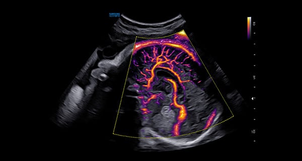 usa-WH-HERA W10_Clinical Images_Fetal Brain-MV-Flow