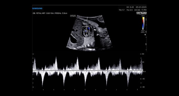usa-WH-HERA W10_Clinical Images_Fetal Heart-PW Doppler