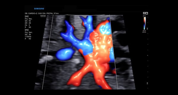usa-WH-HERA W10_Clinical Images_Fetal Heart-S-Flow