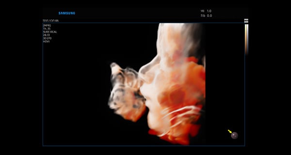 usa-WH-HERA W10_Clinical Images_Fetal Profile-CrystalVue