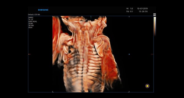 usa-WH-HERA W10_Clinical Images_Fetal Spine-CrystalVue