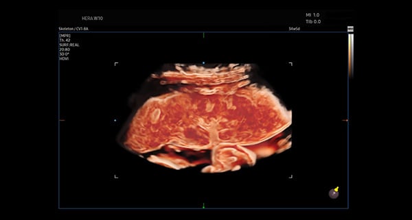 usa-WH-HERA W10_Clinical Images_Placenta-CrystalVue