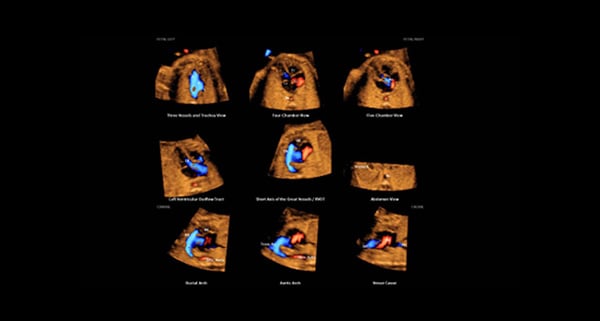 usa-WH-HERA W10_Elevated Diagnostic System_Fetal Heart-5D Heart Color