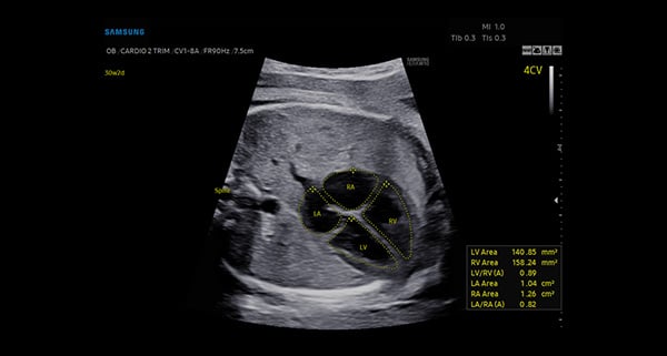 usa-WH-HERA W10_Elevated Diagnostic System_Fetal Heart-HeartAssist