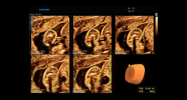 usa-WH-HERA W10_Elevated Diagnostic System_Fetal Thigh-5D Limb Vol