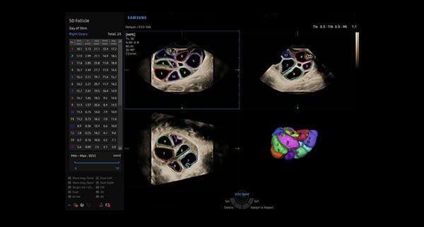 usa-WH-HERA W10_Elevated Diagnostic System_Stimulated Ovary-5D Follicle
