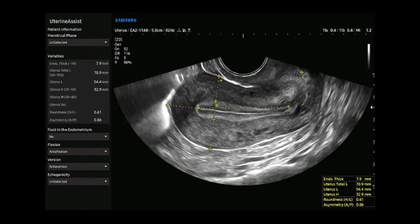 usa-WH-HERA W10_Elevated Diagnostic System_Uterus-UterineAssist
