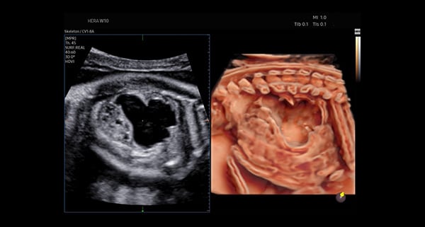 usa-WH-HERA W10_Realism in 3D4D_Dilated Renal Calyx-CrystalVue