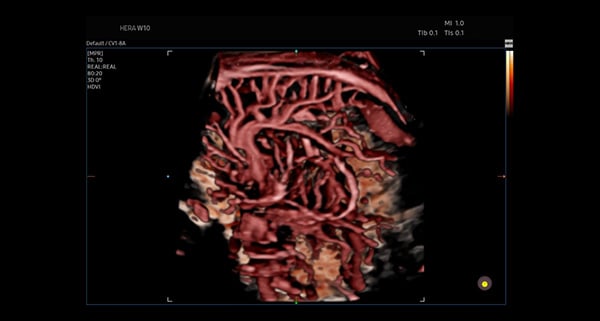 usa-WH-HERA W10_Realism in 3D4D_Fetal Brain Vasculature-CrystalVue Flow