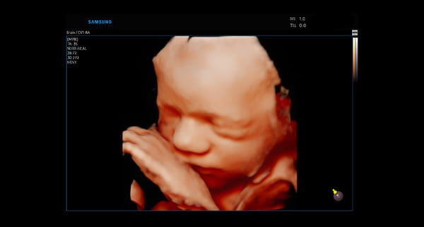 usa-WH-HERA W10_Realism in 3D4D_Fetal Face-Hand-RealisticVue