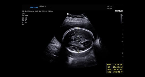 usa-WH-w10-Automated fetal biometry