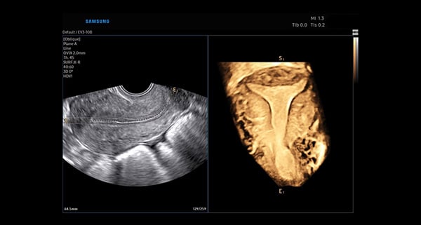 usa-WH-w10-Uterine cornal plane
