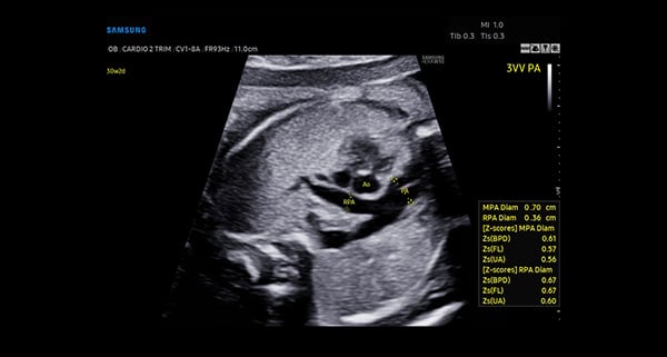 usa-extra image_Fetal 3-Vessel View-HeartAssist