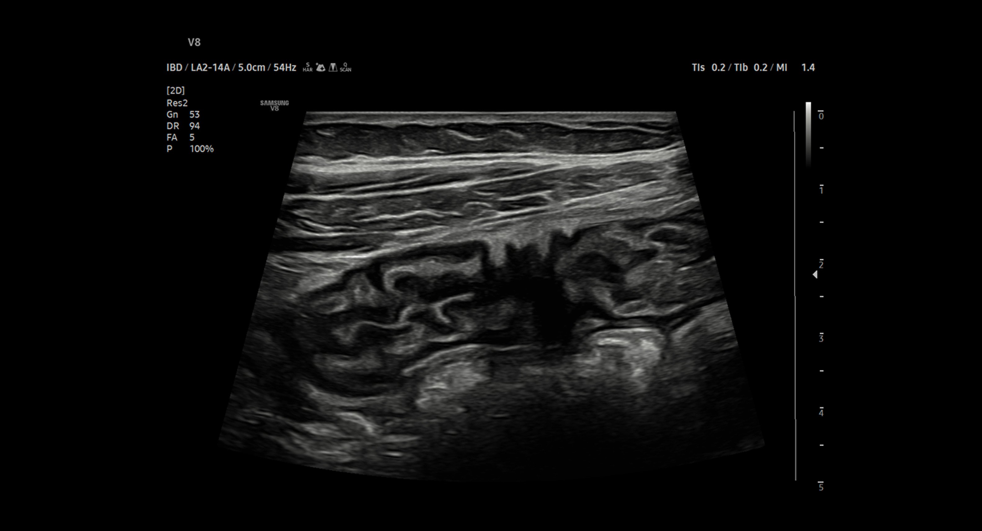 usa-samsung-gi-v8-bowel