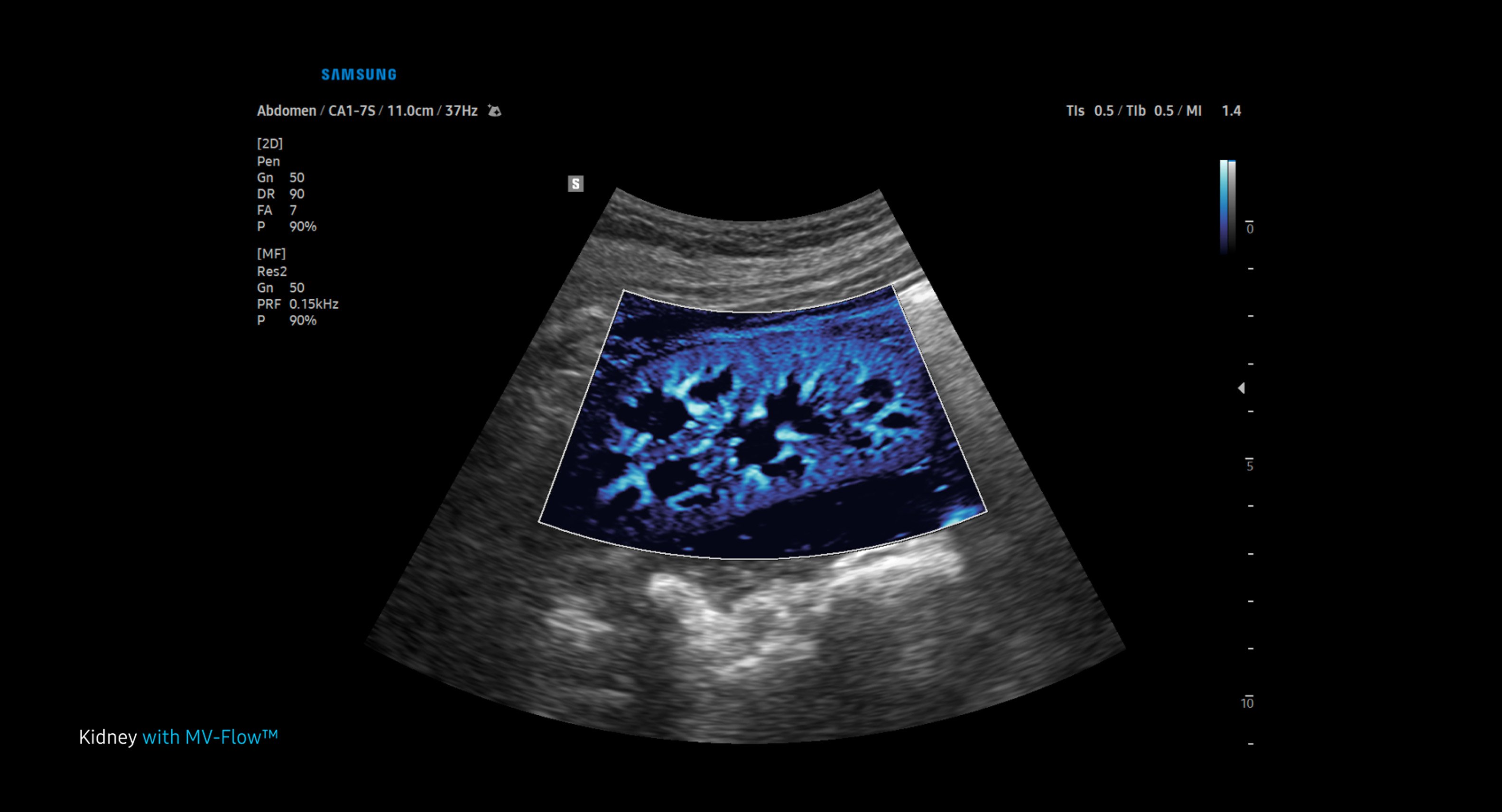 usa-samsung-gi-v8-kidney-mv-flow