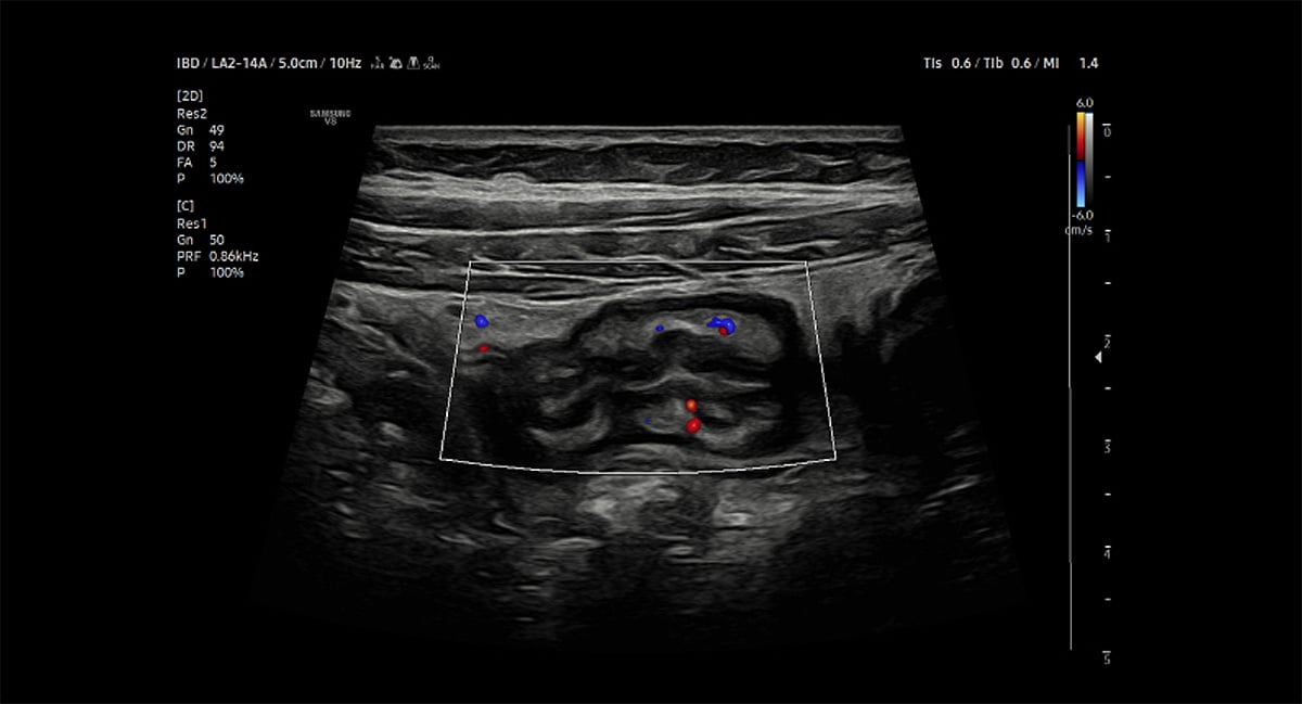 usa-samsung-poc-rs85-bowel