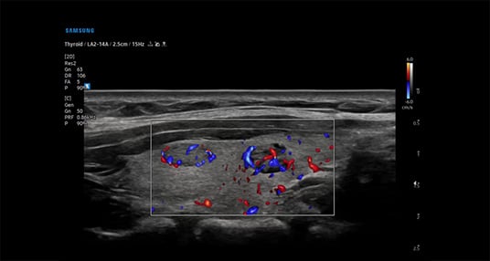 usa-samsung-poc-v8-thyroid-lumi
