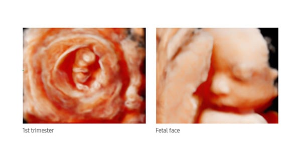 usa-samsung-wh-hm70-fetal-3d