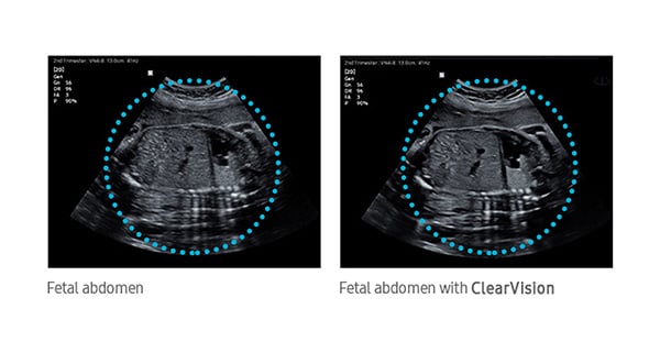 usa-samsung-wh-hm70-fetal-abdo