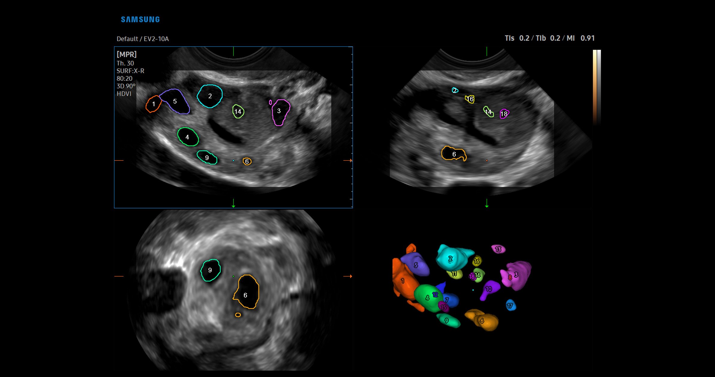 usa-samsung-wh-v5-carousel-5D-Follicle
