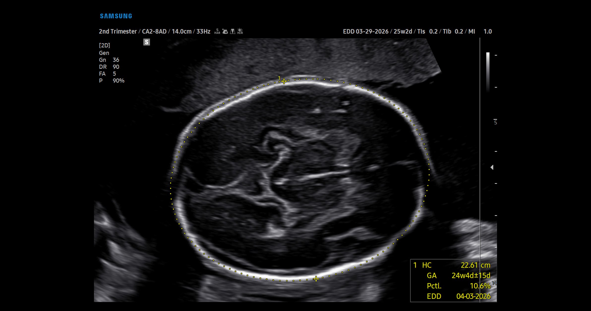 usa-samsung-wh-v5-carousel-BiometryAssist-25-Wk-Fetal-Head