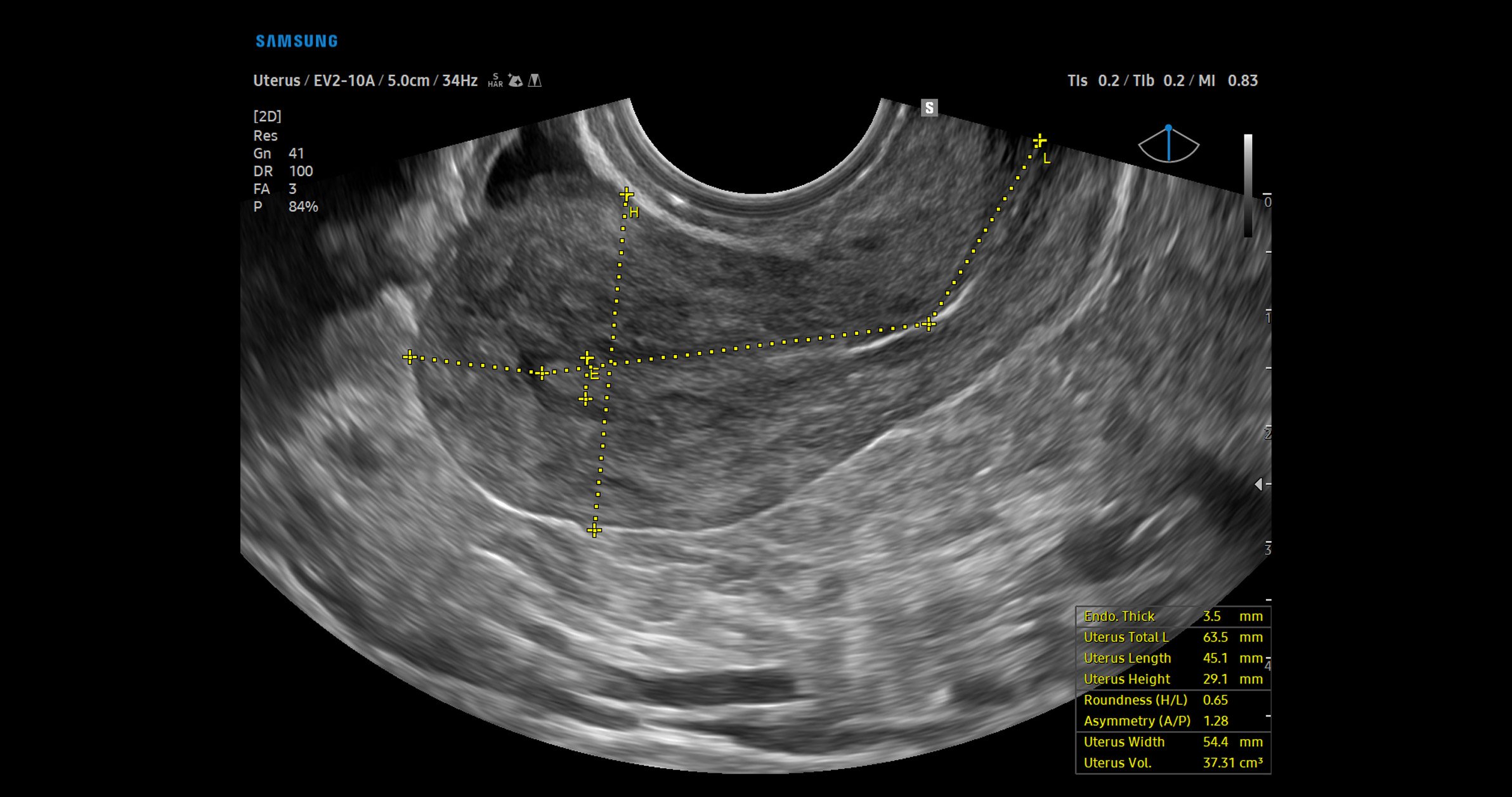 usa-samsung-wh-v5-carousel-UterineAssist