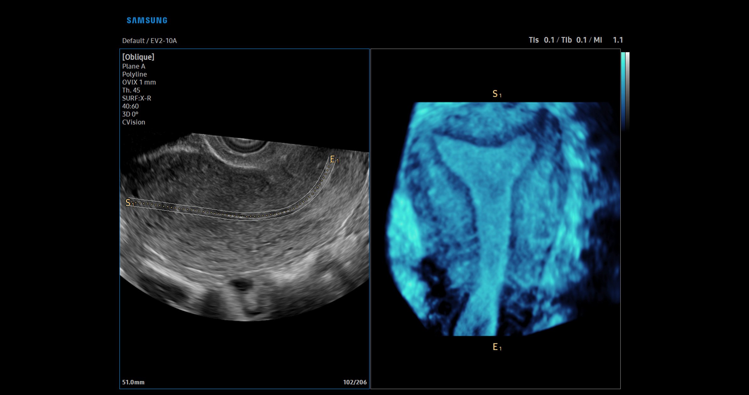 usa-samsung-wh-v5-carousel-UterineCountour