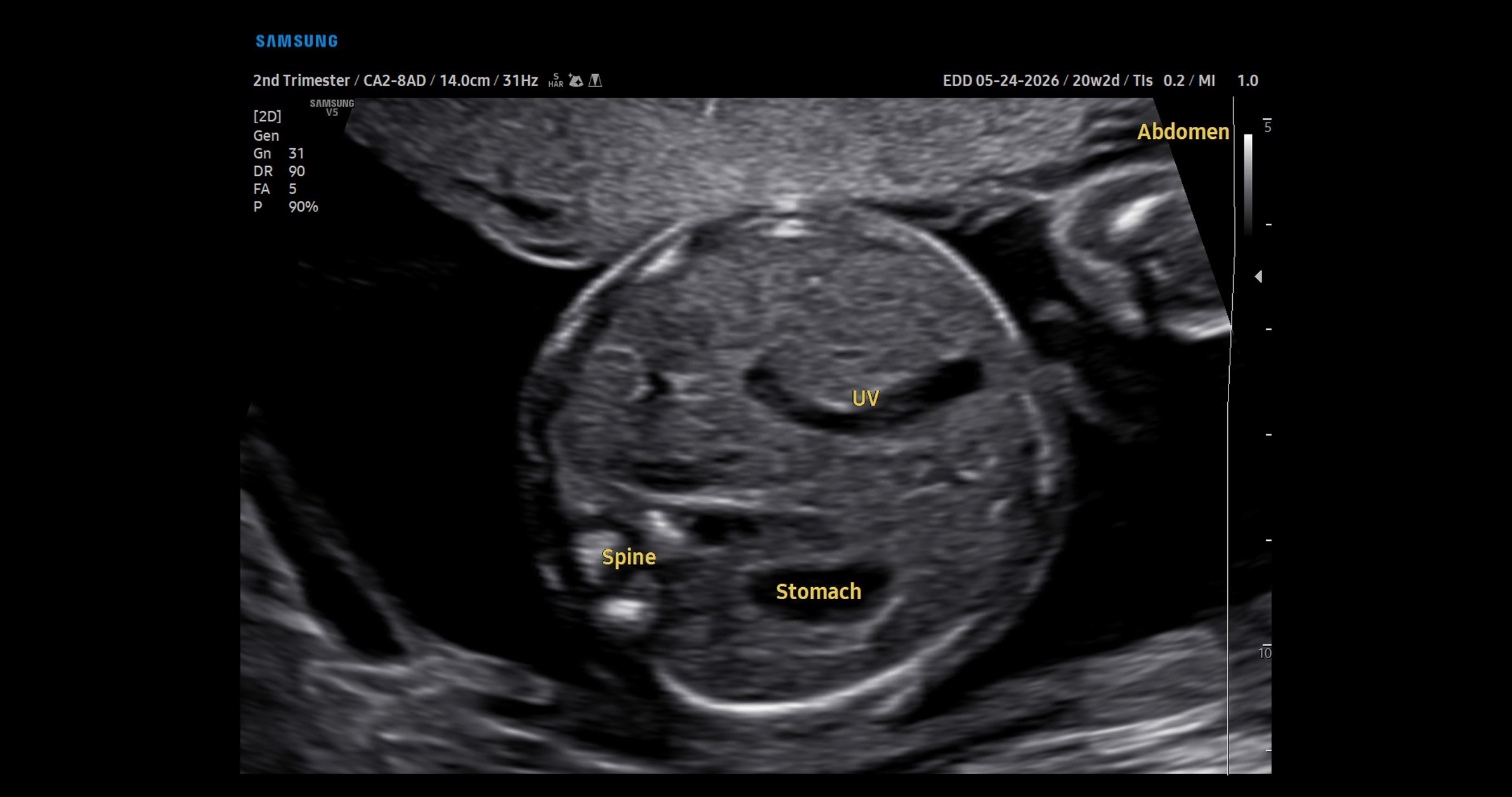 usa-samsung-wh-v5-carousel-ViewAssist-20-Wk-Fetal-Abdomen