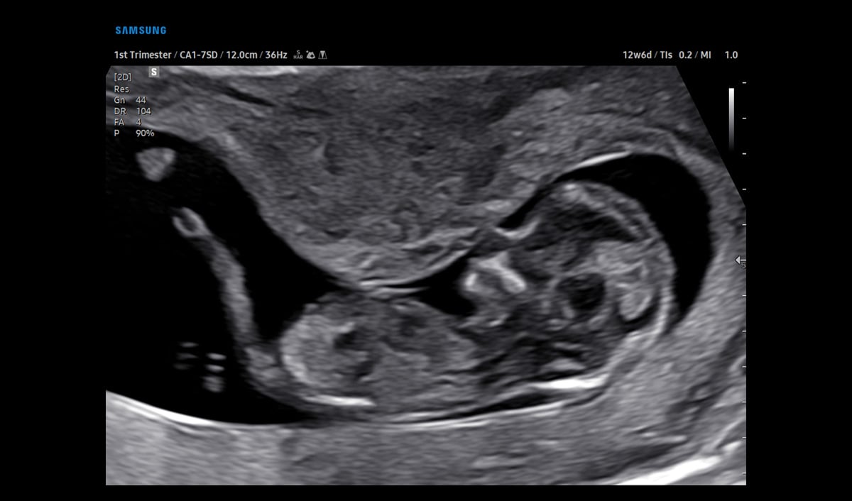 usa-samsung-wh-v5-rotator-13wk-fetus-1