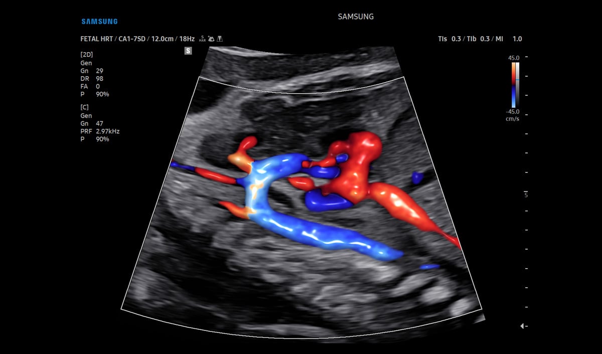 usa-samsung-wh-v5-rotator-Color-Doppler-Fetal-Heart-1
