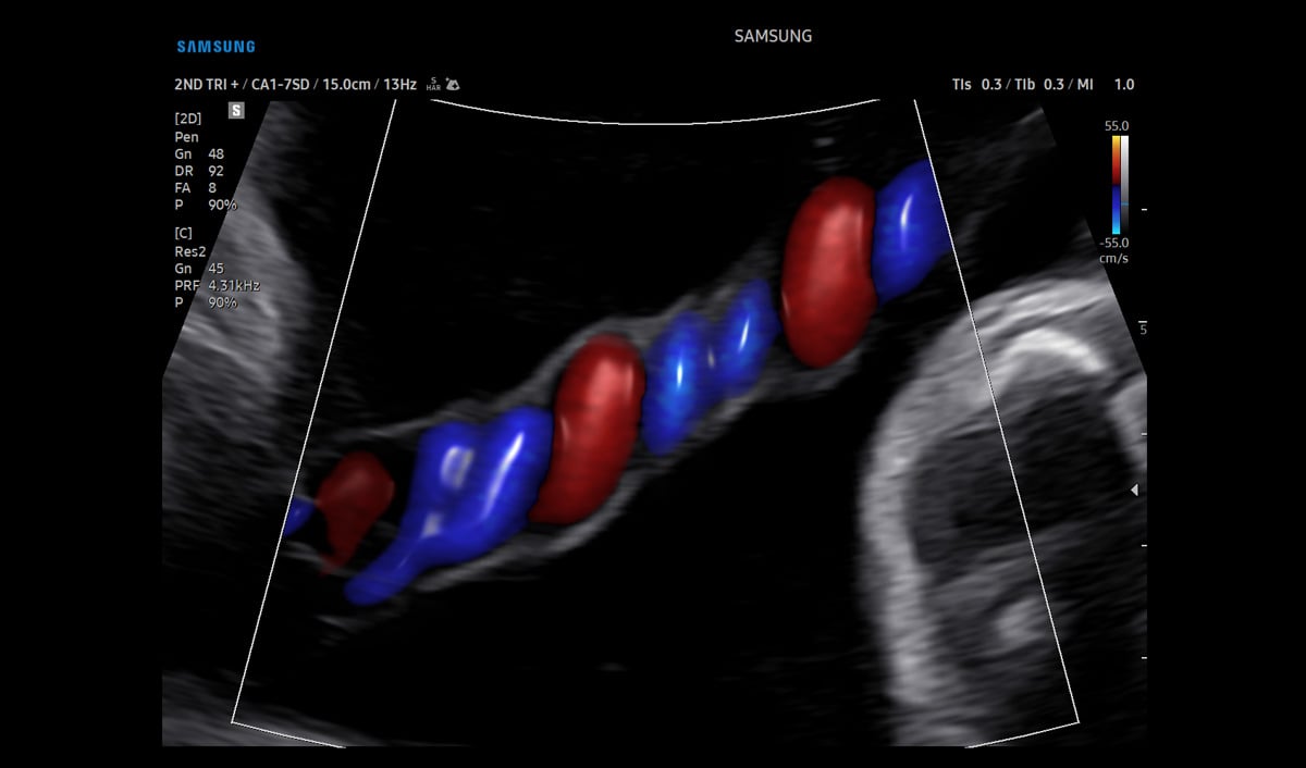 usa-samsung-wh-v5-rotator-Color-Doppler-Umbilical-Cord-1