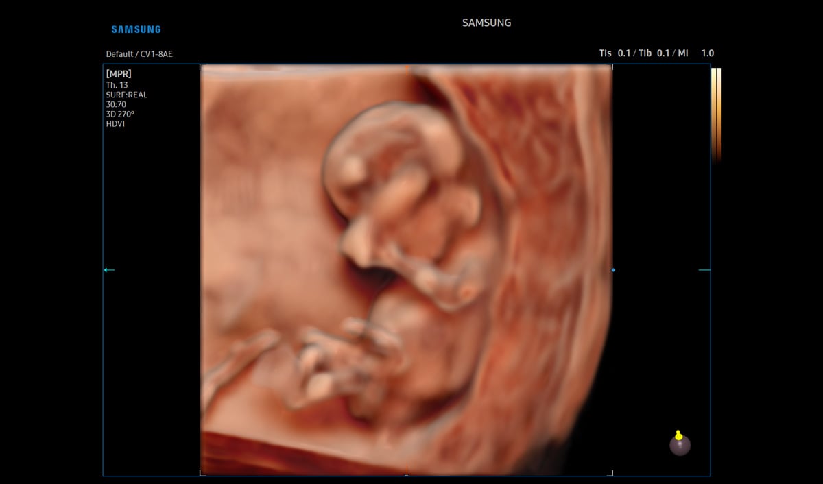 usa-samsung-wh-v5-rotator-HDVI-1st-Trimester-Fetus-1
