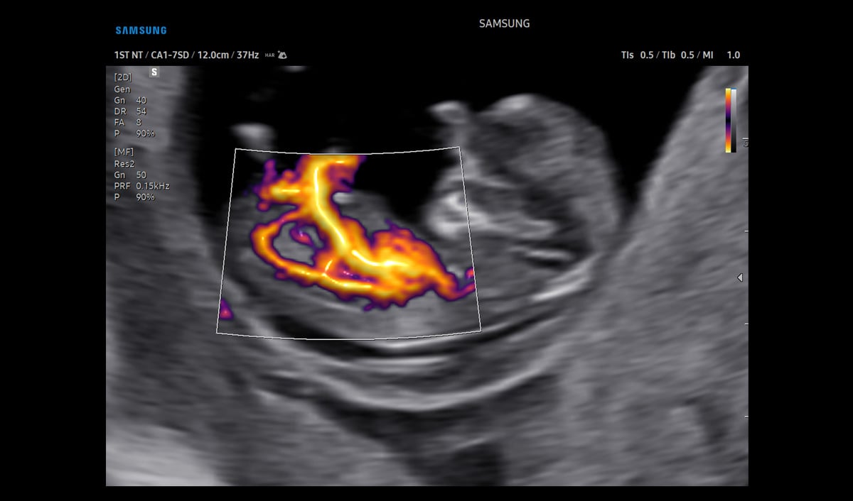 usa-samsung-wh-v5-rotator-MV-Flow-1st-Trimester-Fetus-1