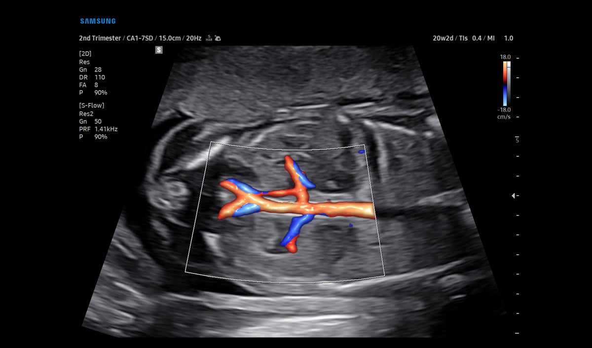 usa-samsung-wh-v5-rotator-S-Flow-20Wk-Fetal-Aorta-Renal-Vessels-1