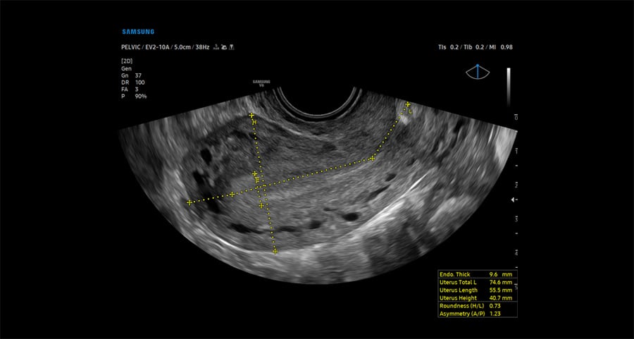 usa-samsung-wh-v6-uterine-assist